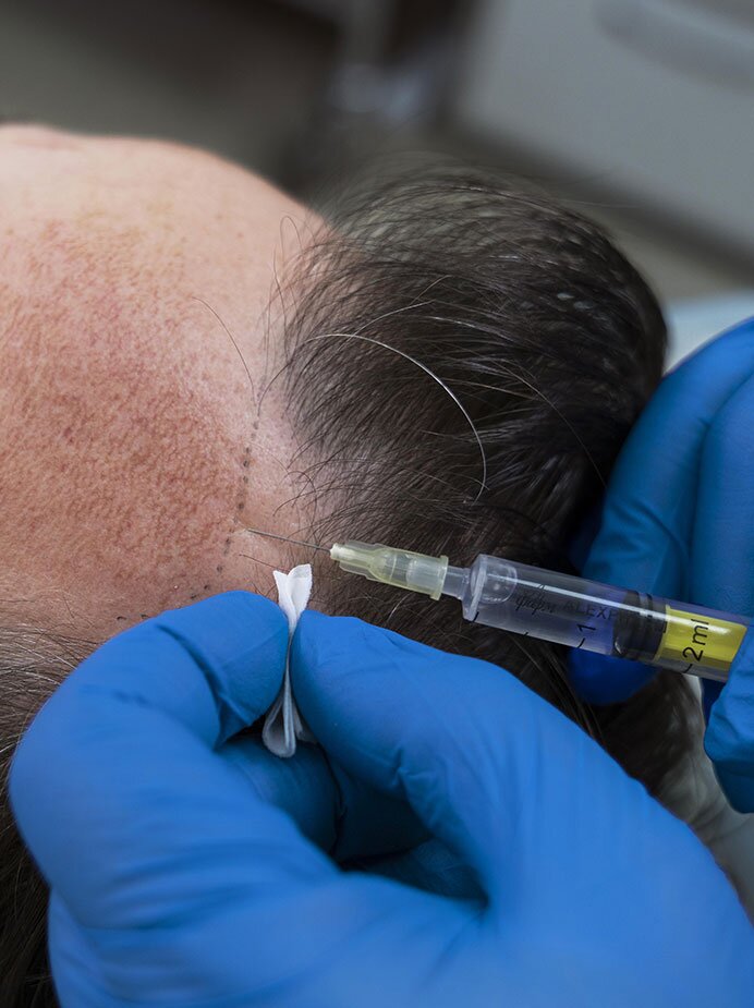 home-prp-hair-treatment-img1-navjeevanskinclinic