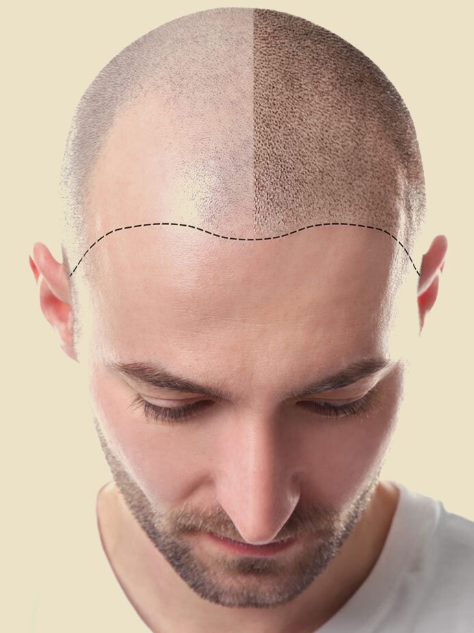 home-smp-hair-treatment-img1-navjeevanskinclinic